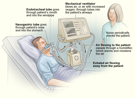 Ventilators Ventilators